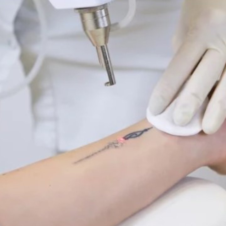 tattoo removal panmed