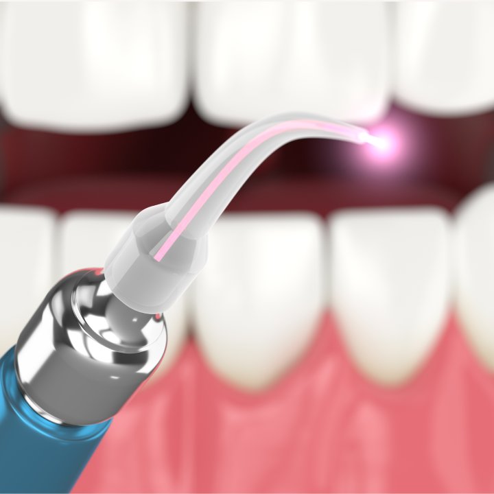 tooth root canal treatment